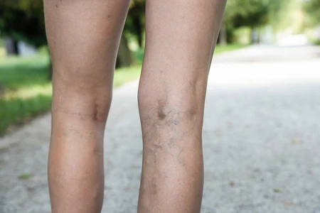 Varicose veins: Causes, treatment, diagnosis, and prevention