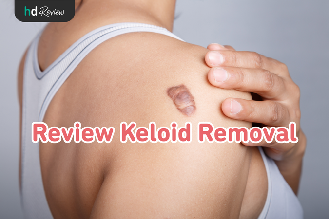 Keloid Removal reviews