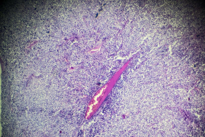 Rhabdomyosarcoma