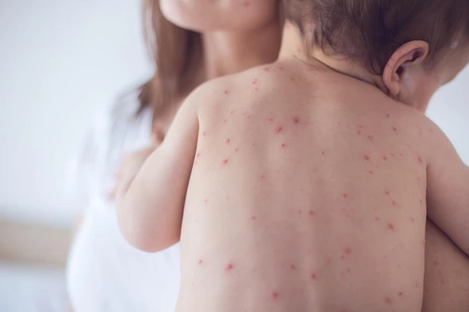 Roseola