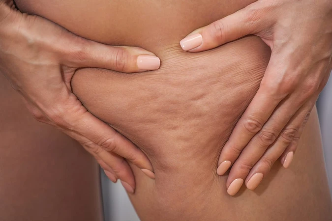 Selulitis