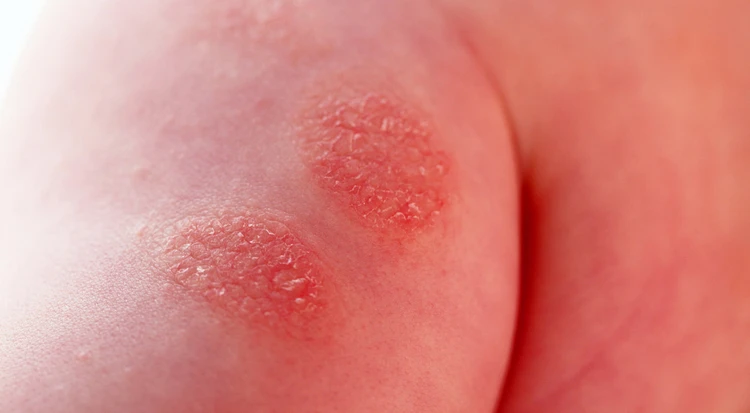 Pruritus