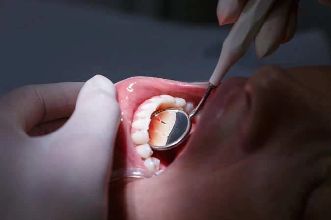 Periodontitis