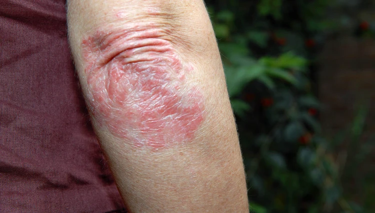 Neurodermatitis