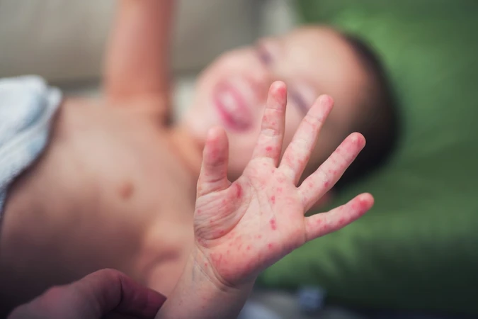 Measles (Penyakit Campak)