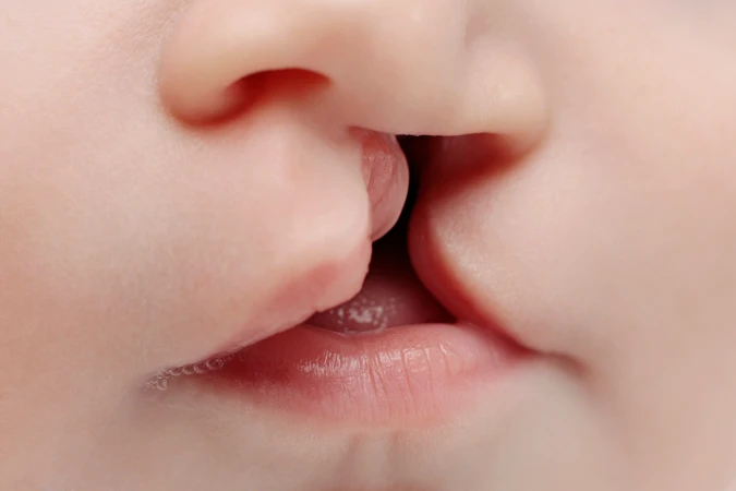 Bibir Sumbing (Harelip)