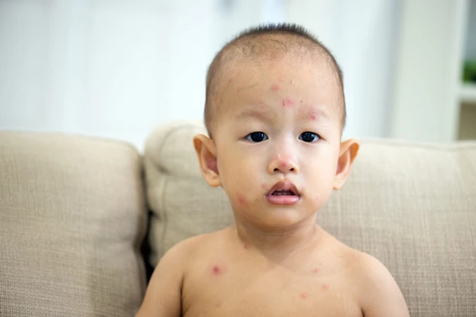 Cacar Air (Chicken Pox)
