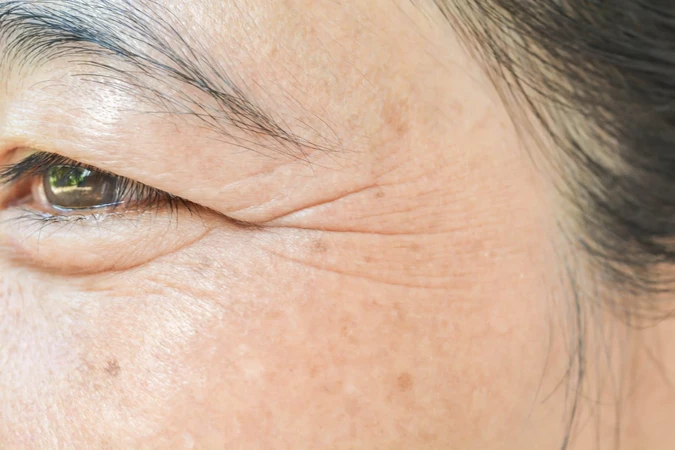 Keriput (Wrinkled)