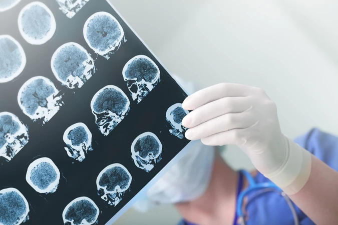 Kanker Otak (Brain Cancer)