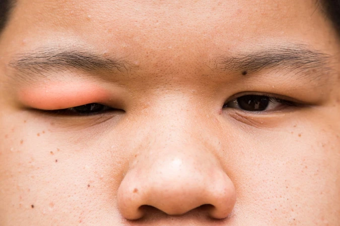 Blefaritis (Blepharitis)