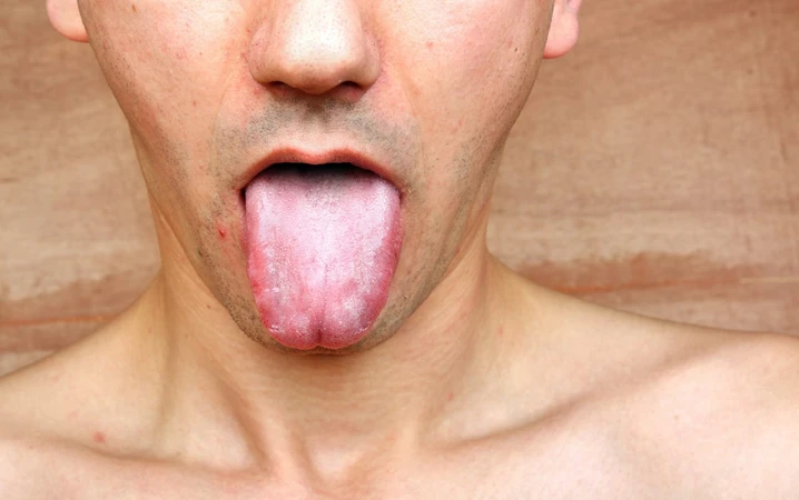 Oral Leukoplakia