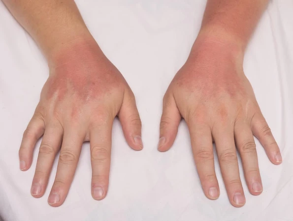Dermatomyositis (Dermatomiositis)
