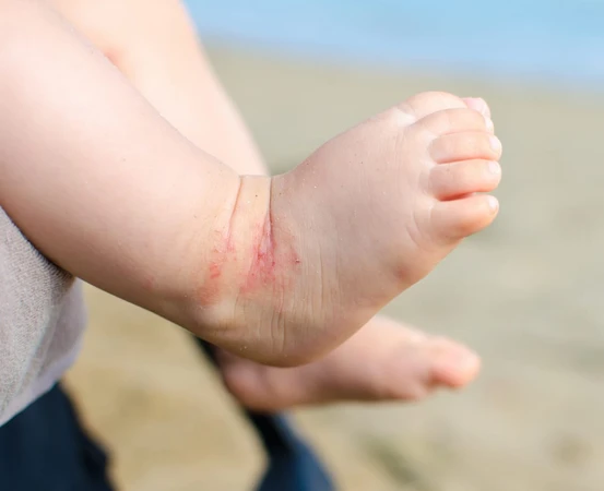 Eksim Atopik (Atopic Eczema)