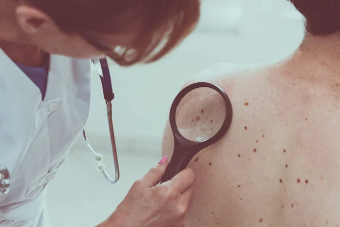 Basal Cell Carcinoma (Karsinoma Sel Basal)
