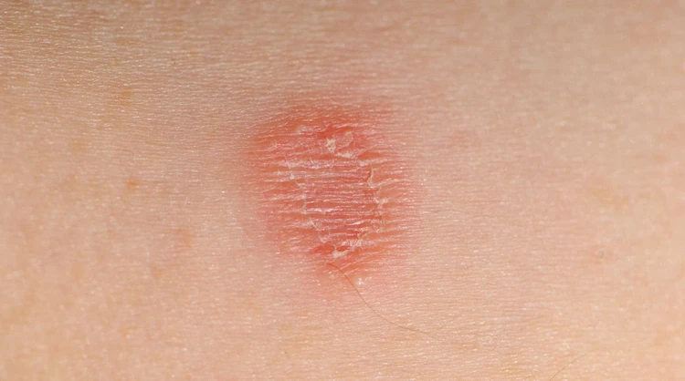 Tinea Corporis