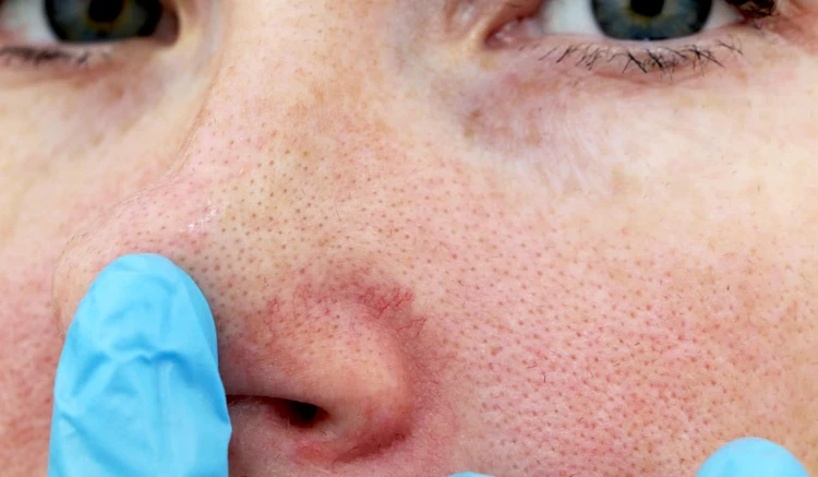 Rosacea