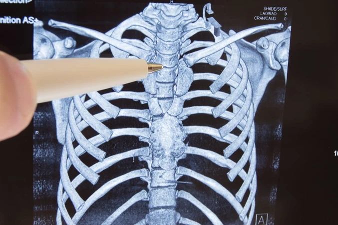 Osteosarcoma (Osteosarkoma)