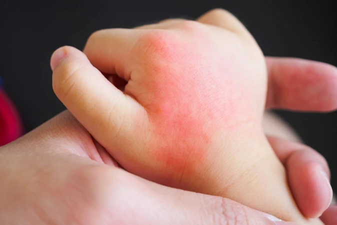Hemangioma (Hemangiomas)