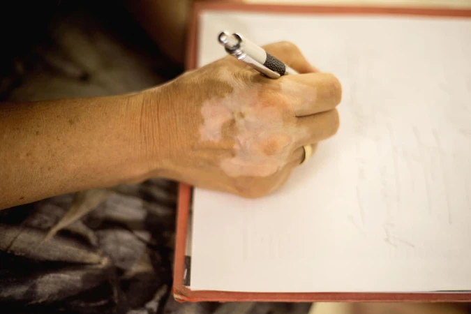 Vitiligo