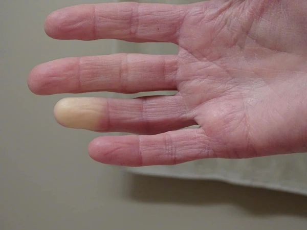 Scleroderma (Skleroderma)