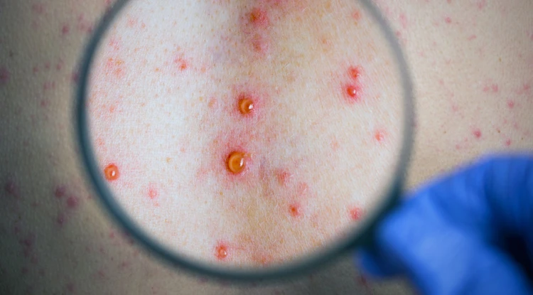 Syphilis