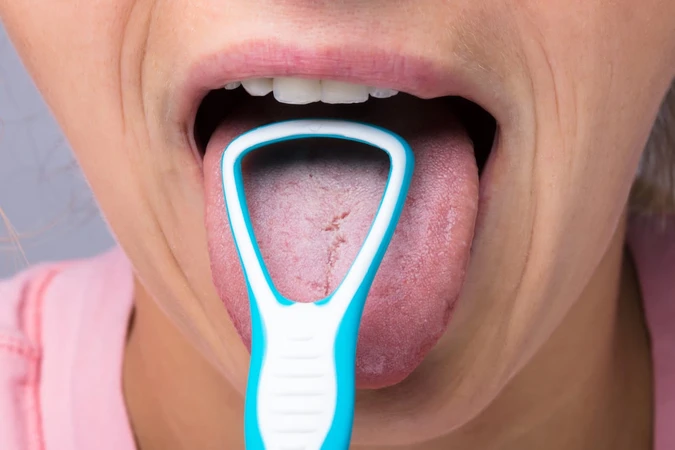 Kanker Lidah (Tongue Cancer)