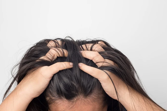 Kutu Rambut (Lice)