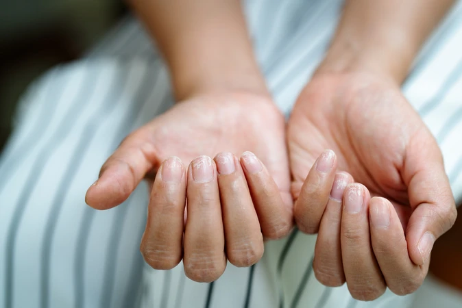 Marfan Syndrome (Sindrom Marfan)