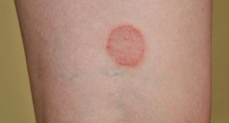 Lichen Planus