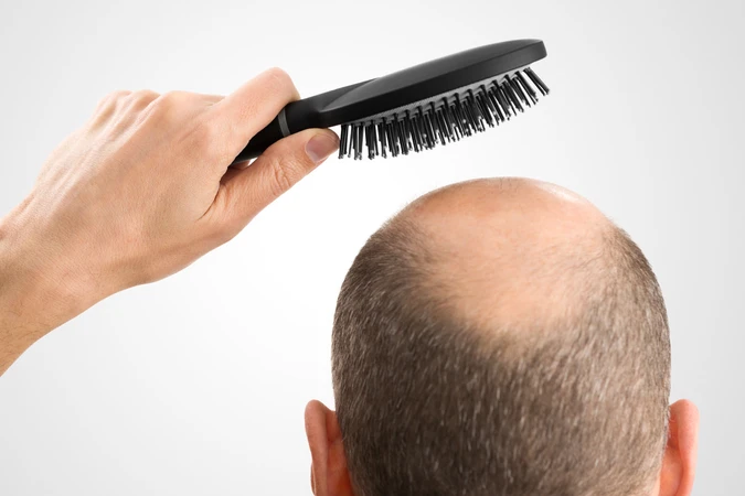 Alopecia Areata