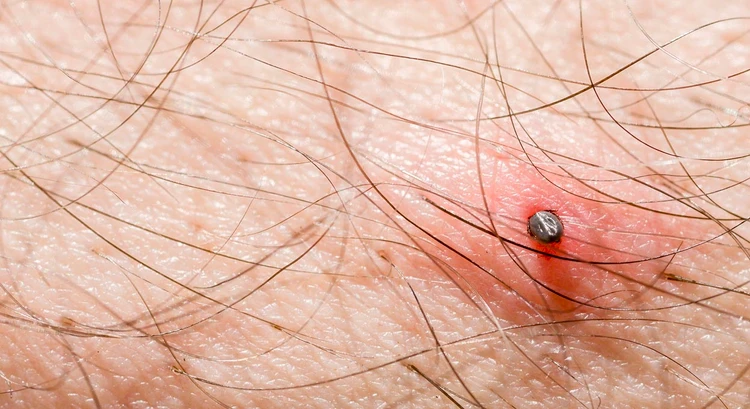 Tifus (Typhus)