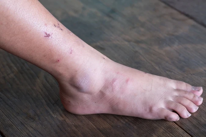 Ulkus Kaki