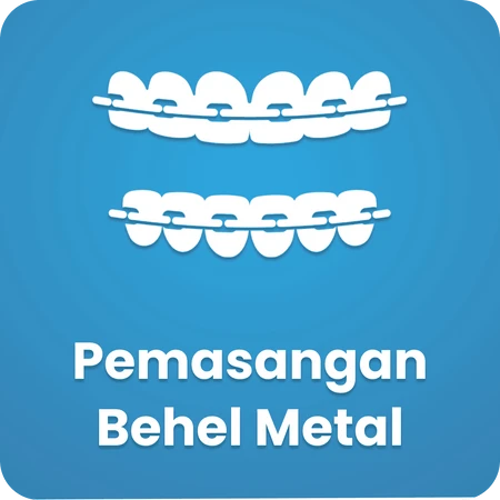 Pemasangan Behel Metal
