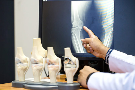 Ketahui Apa Perbedaan Osteoporosis dan Osteopenia 
