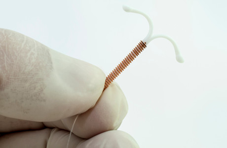 Bagaimana Cara Pemasangan Intraurine Device (IUD) 
