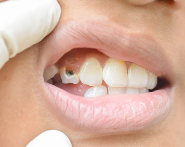 Bahaya Gigi Berlubang Jika Tak Dirawat