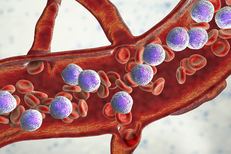 Kenali Faktor Penyebab Leukemia yang Bisa Terjadi Pada Siapa Saja