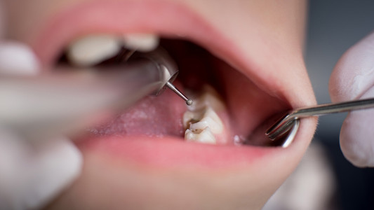 12 Penyebab Gigi Berlubang Yang Tak Boleh Diremehkan