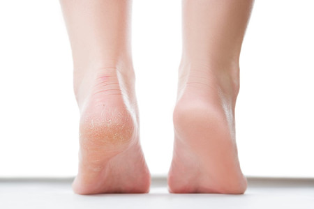 Telapak kaki berkeringat tanda penyakit apa