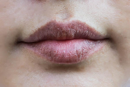 Penyebab Bibir Kering dan Pecah-Pecah Bukan Hanya Dehidrasi Saja