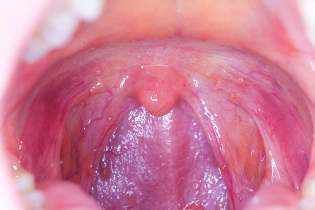 Dehidrasi Bisa Sebabkan Infeksi di Mulut