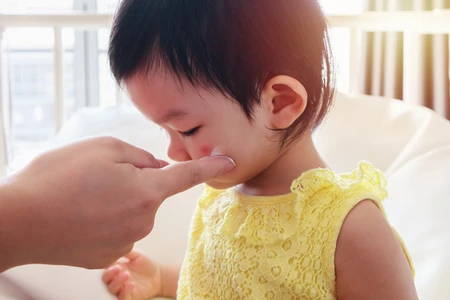 5 Cara Mengobati Dermatitis Atopik Pada Bayi