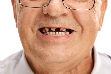 Tips Mencegah Gigi Ompong Saat Tua