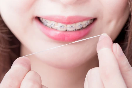 Pengguna Behel Gigi Juga Wajib Pakai Benang Gigi, Ini Manfaatnya