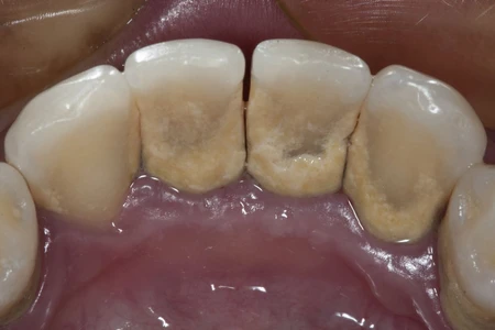 Kenali Penyebab dan Penanganan Pada Tartar Gigi