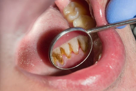 Dampak Karang Gigi bagi Kesehatan Mulut