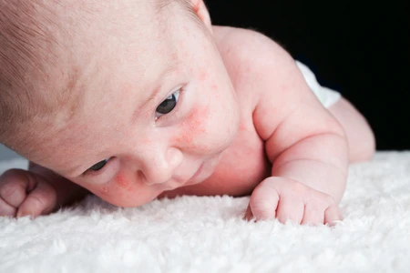 Bintik Putih Pada Wajah Bayi, Berbahaya Atau Tidak?
