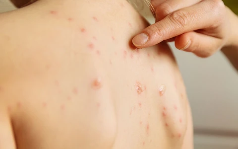 Infeksi Virus Apa Saja yang Bisa Diatasi dengan Acyclovir?