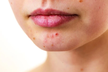Bukan Jerawat, Ini Ciri-ciri Fungal Acne yang Penting Diketahui