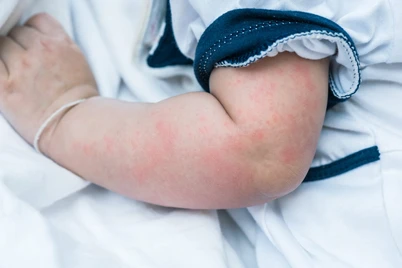 Penyebab Bintik Merah Pada Kulit Bayi Setelah Demam
